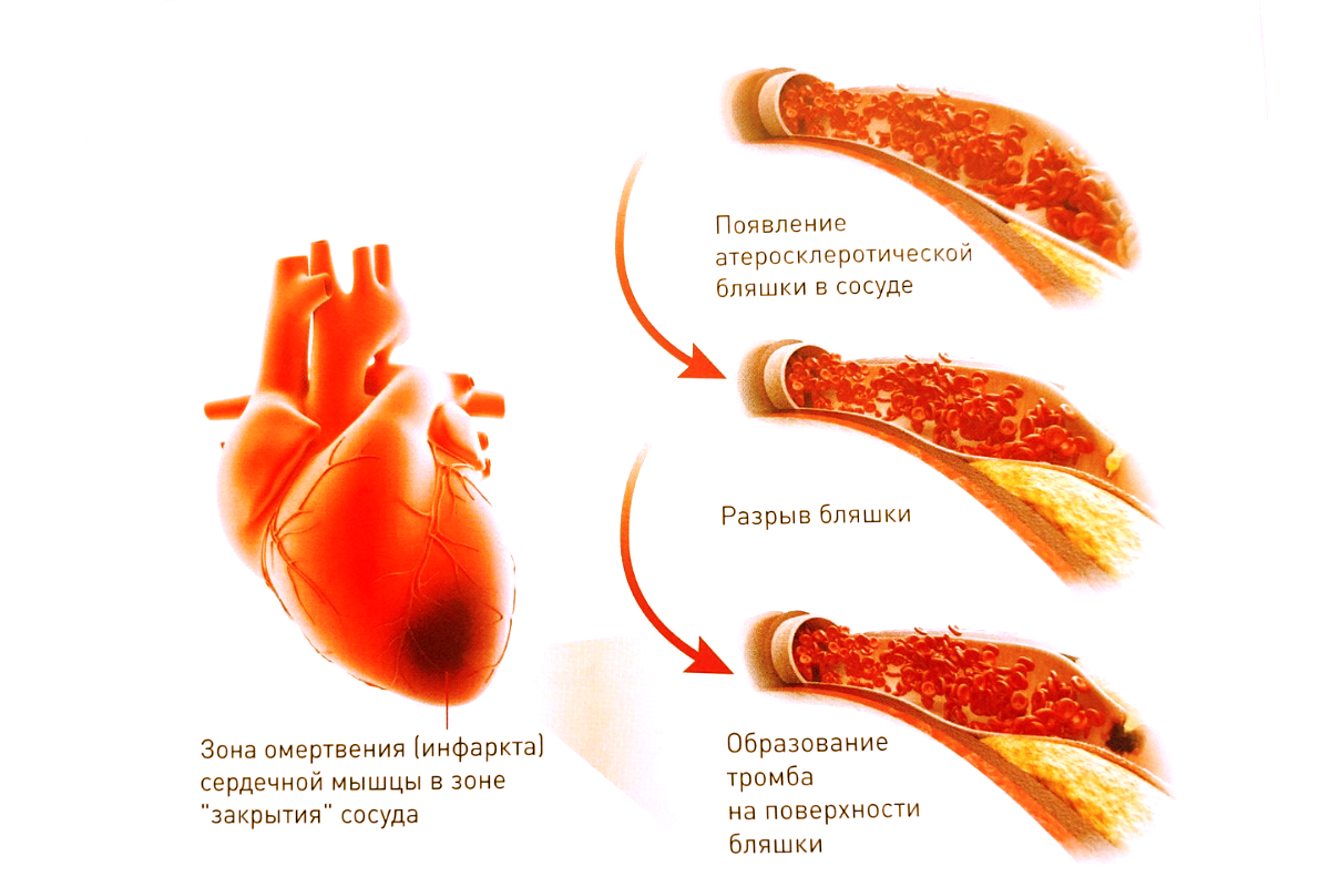 Ишемическая болезнь сердца и стентирование: что нужно знать пациенту