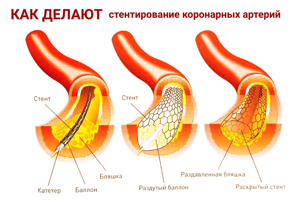 Стентирование коронарных артерий