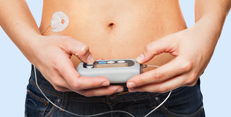 Инсулиновая помпа вместо инъекций: кому подходит и как установить