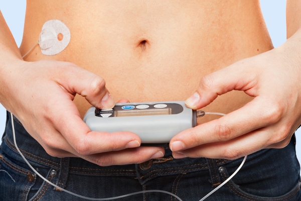 Инсулиновая помпа вместо инъекций: кому подходит и как установить