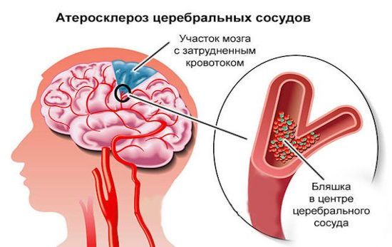 Очаговые изменения мозга дистрофического дисциркуляторного характера