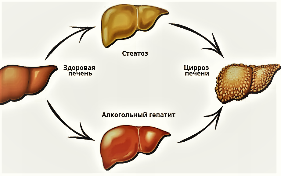 К чему может привести печени. Стадии поражения печени алкоголем. Схема развития цирроза печени. Алкогольное поражение печени и ЖКТ, механизмы развития. Механизмы алкогольного поражения печени..